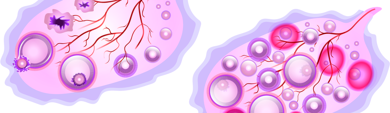 ovary-g5474488c0_1920 שחלות פוליציסטיות